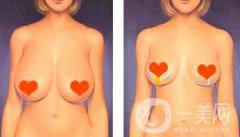 乳房下垂矯正方法介紹 乳房下垂矯正手術(shù)多少錢