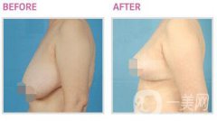 乳房太大如何縮小 乳房縮小提升手術(shù)圖片