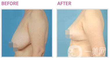 乳房太大如何縮小 乳房縮小提升手術(shù)圖片