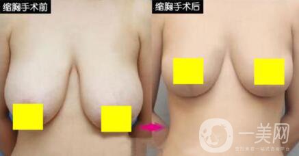 乳房太大如何縮小 乳房縮小提升手術(shù)圖片
