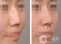 駝峰鼻矯正方法介紹 杭州駝峰鼻矯正多少錢