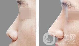 上海鼻小柱延長價格 鼻小柱延長手術(shù)多少錢