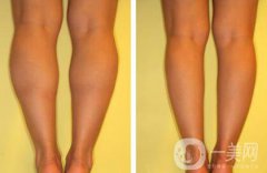 注射瘦臉瘦小腿多少錢 注射瘦臉瘦小腿價(jià)格詳情