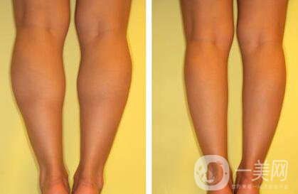 *瘦小腿多少錢 *瘦小腿價(jià)格詳情