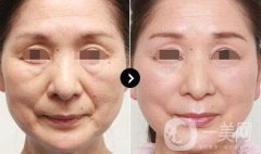 伊維蘭填充除皺價(jià)格 伊維蘭填充除皺多少錢