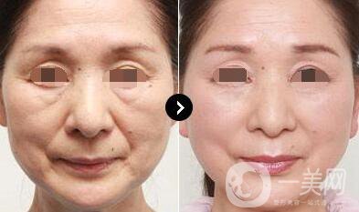 伊維蘭填充除皺價格 伊維蘭填充除皺多少錢