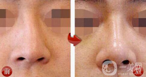 深圳歪鼻矯正一般多少錢 歪鼻矯正的價(jià)格詳解