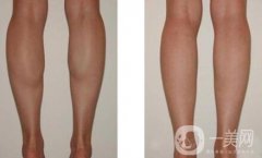 廣東注射瘦腿多少錢 注射瘦腿價格詳解