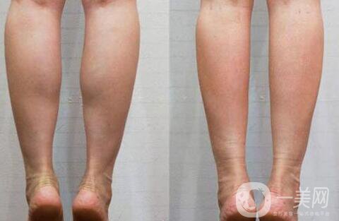 廣東注射瘦腿多少錢 注射瘦腿價格詳解