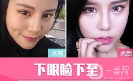 下眼下至,術(shù)后護理