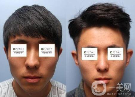 鼻歪矯正手術(shù)痛苦嗎？ 鼻歪矯正手術(shù)有多痛苦？