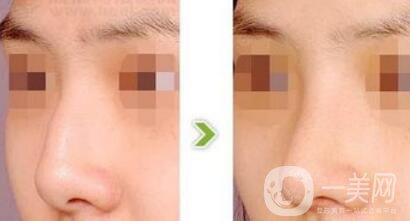 駝峰鼻矯正價錢 駝峰鼻矯正手術具體費用