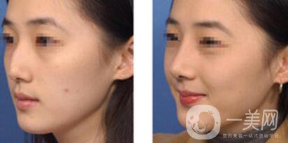 駝峰鼻矯正價錢 駝峰鼻矯正手術具體費用