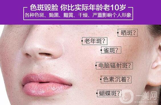 如何去老年斑 老年斑如何去除