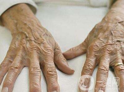 老年斑如何調(diào)節(jié) 老年斑怎么調(diào)節(jié)