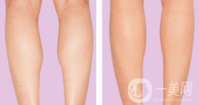 *瘦小腿*果 **怎么樣