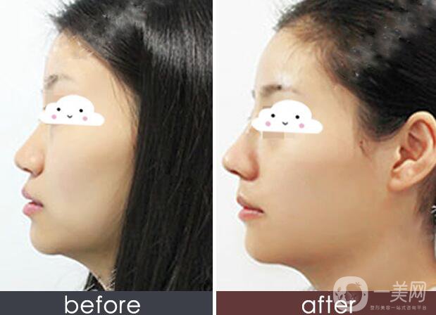 *多久恢復(fù)自然 *術(shù)后幾天恢復(fù)