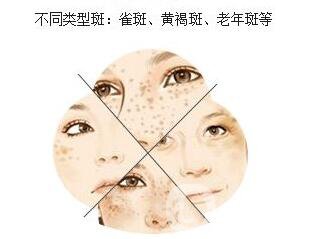 手背長(zhǎng)老年斑怎么辦 如何去除