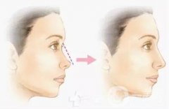 瑞蘭玻尿酸隆鼻價格 瑞蘭玻尿酸隆鼻多少錢