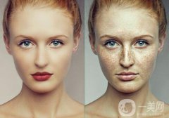 黃褐斑怎樣形成的 黃褐斑生成原因