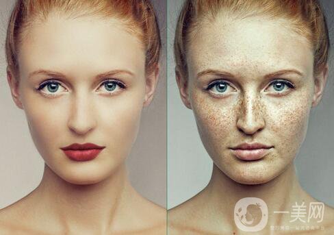 黃褐斑怎樣形成的 黃褐斑生成原因