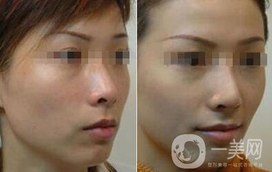 光子嫩膚的費(fèi)用 光子嫩膚具體價格