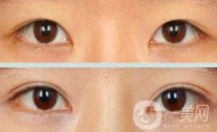 割雙眼皮疼不疼？打了麻藥還疼嗎？