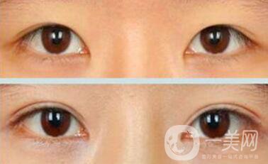 割雙眼皮疼不疼？打了麻藥還疼嗎？