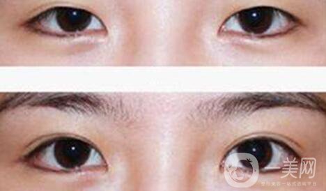 割雙眼皮疼不疼？打了麻藥還疼嗎？