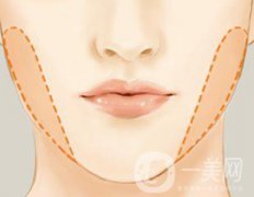 去頰脂墊多久恢復(fù) 與哪些因素有關(guān)？