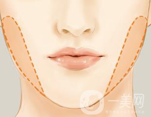 去頰脂墊多久恢復(fù) 與哪些因素有關(guān)？