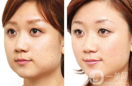 去頰脂墊多久恢復(fù) 與哪些因素有關(guān)？