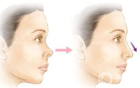 朝天鼻矯正注意事項 朝天鼻矯正如何護(hù)理