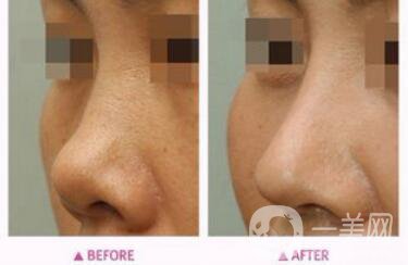 朝天鼻矯正注意事項 朝天鼻矯正如何護(hù)理