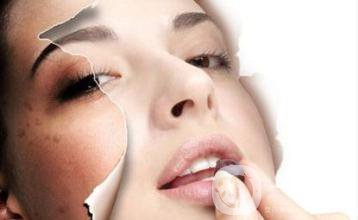 蝴蝶斑怎么去?價格一般是多少？