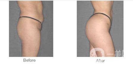 廣東豐臀手術(shù)多少錢 影響因素有哪些？