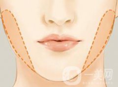 去頰脂墊多少錢 去頰脂墊價格一般是多少