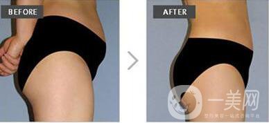 廣東,臀部抽脂,多少錢