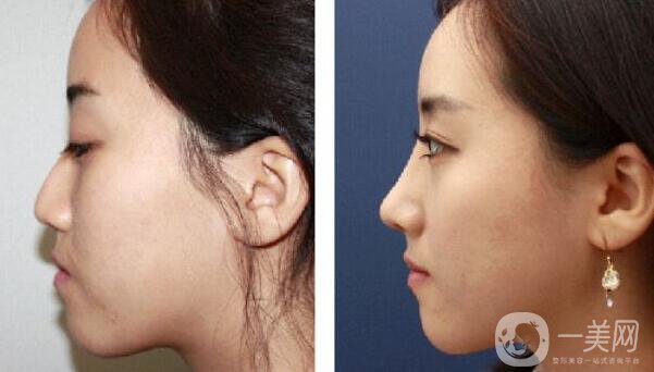 深圳,自體隆鼻,多少錢