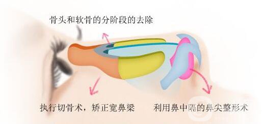 駝峰鼻矯正費(fèi)用 駝峰鼻矯正價(jià)格盤點(diǎn)
