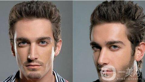 鬢角移植多少錢 鬢角移植價(jià)格是多少