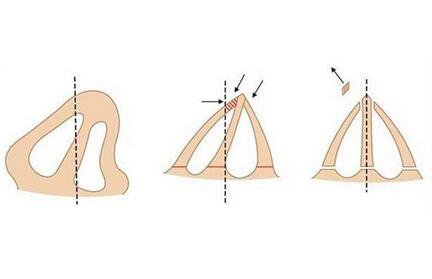 上海鼻梁骨矯正手術(shù)費(fèi)用 價(jià)格盤(pán)點(diǎn)