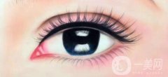 眼瞼下至多久后會(huì)回縮 眼瞼下至術(shù)后護(hù)理
