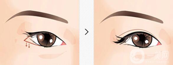 眼瞼下至多久后會回縮 眼瞼下至術(shù)后護(hù)理