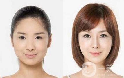 頰脂墊去除后還會長嗎 去頰脂墊*果保持多久