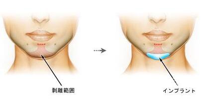 墊下巴用什么材料好 墊下巴要多少錢