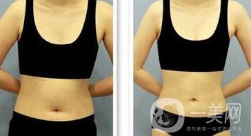 腰腹環(huán)形吸脂