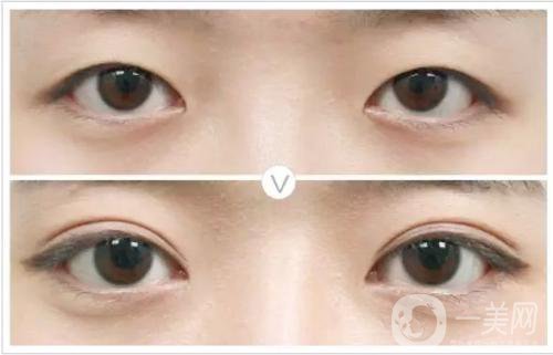 割雙眼皮和埋線哪個*果比較好？