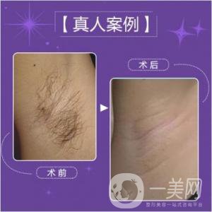 激光脫毛多少錢(qián)一次比較合理？