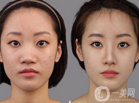 北京*整形多少錢 和哪些因素有關(guān)？